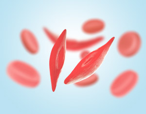 Sickle Cell
