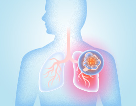 Chronic Obstructive Pulmonary Disease